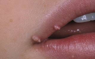 Папилломы на губе