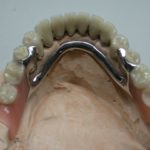 Условно съемное протезирование зубов