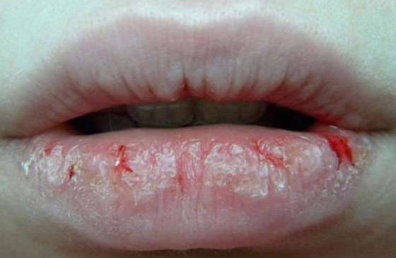 Обветренные губы
