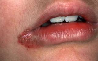 Сифилис на губах