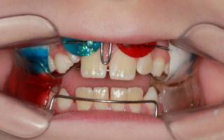 Двучелюстная ортодонтическая пластина