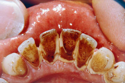Черный налет на зубах: причины, профилактика и методы избавления