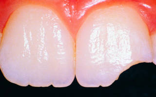 Разрушение зубной эмали