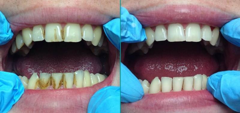 До и после ультразвуковой чистки зубов