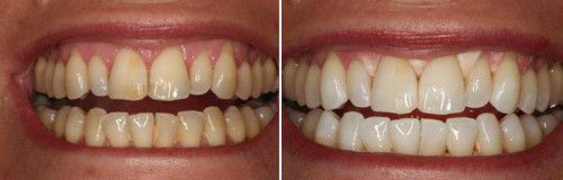 До и после чистки зубов