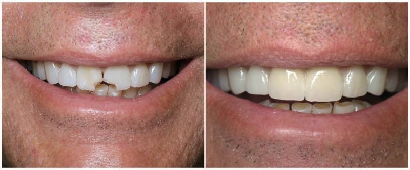 Результат наращивания передних зубов