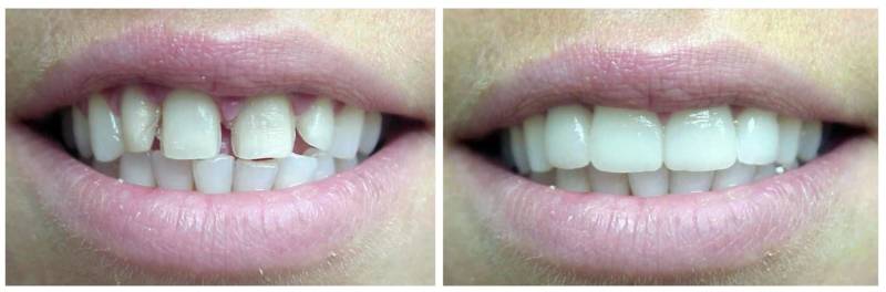 Результат реставрации зубов