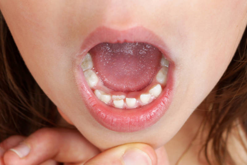 Что делать, если у ребенка зубы растут вторым рядом