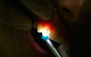 Транслюминация зуба