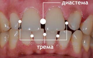Диастема зубов