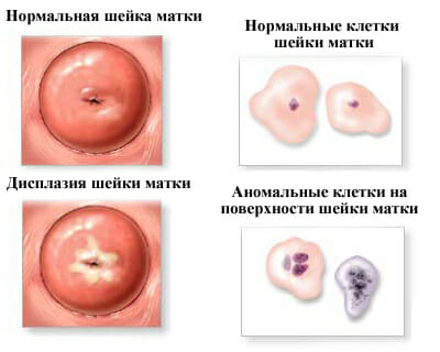 клетки шейки матки при дисплазии