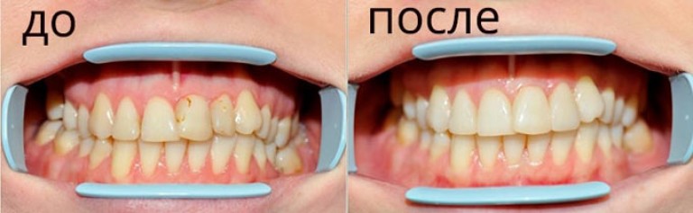 Фторирование зубов до и после