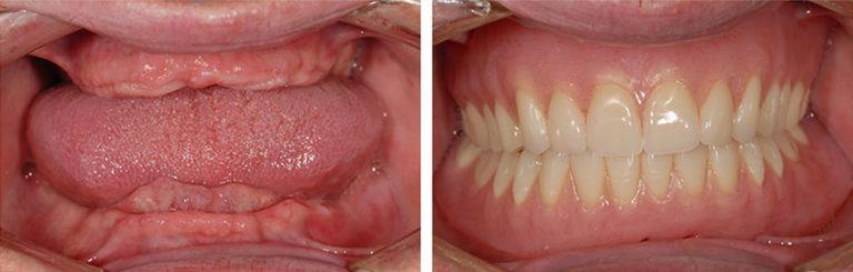 До и после протезирования зубов