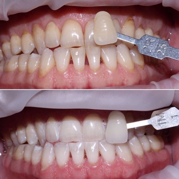 Отбеливание зубов - до и после