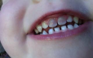 Темная эмаль зубов
