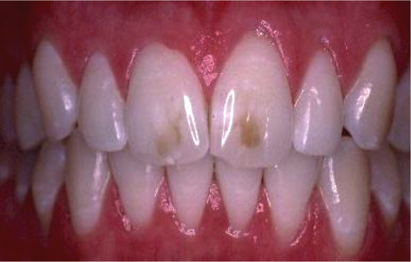 Гипоплазия зубной эмали у детей фото