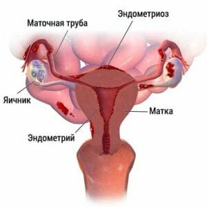 Эндометриоз в матке