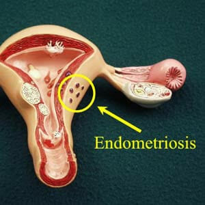 Эндометриоз на макете матки