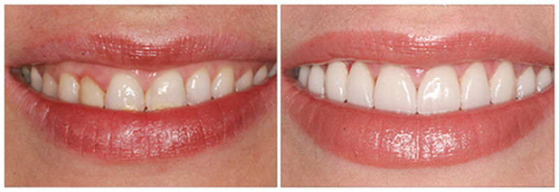 Зубы до и после установки виниров