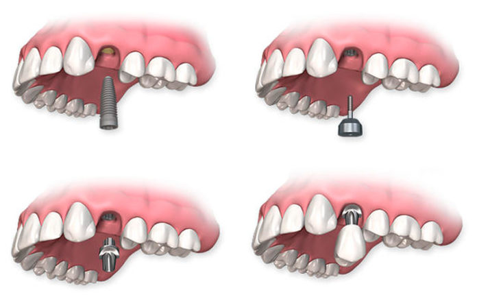 Протезирование зуба