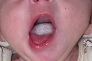 Молочница во рту у ребенка