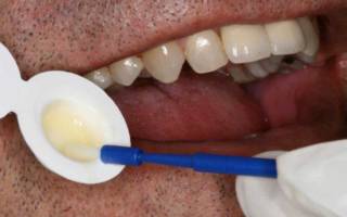 Процесс фторирования зубов