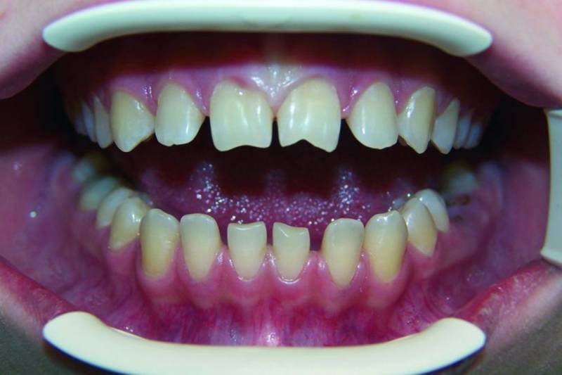 Как выглядят Зубы Гетчинсона