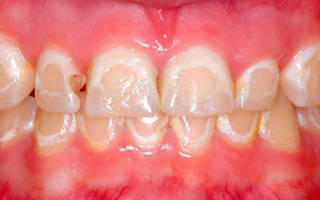Гипоплазия эмали постоянных зубов