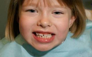 Кривые зубы у девочки