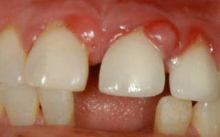 Гранулема на зубе