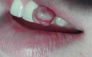 Пиогенная гранулема на губе
