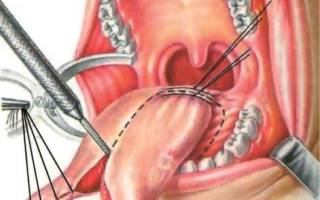 Хирургическое удаление рака языка