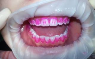Диагностическое окрашивание зубов