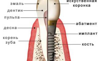Строение импланта зуба