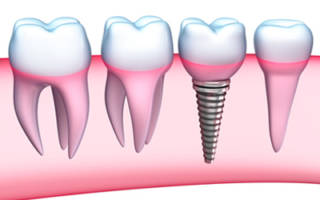 Имплант зуба