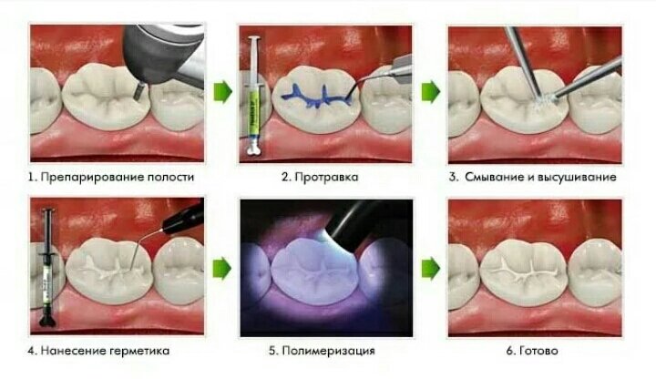 Инвазивный метод герметизации зубов