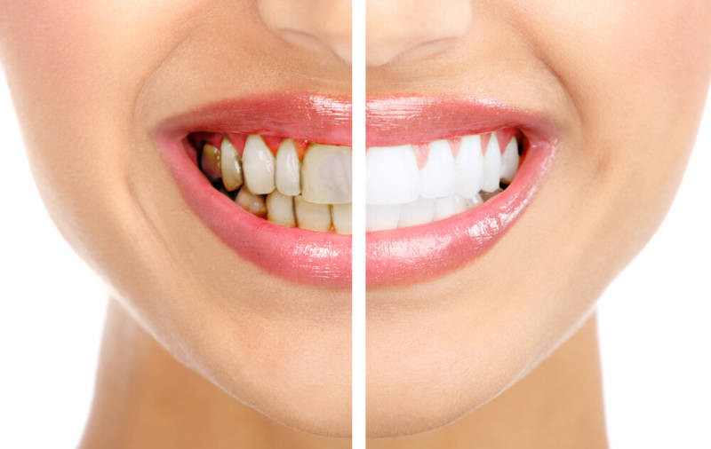 До и после удаления зубного камня