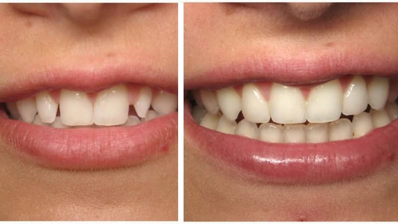 До и после наращивания зубов