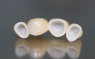 Керамические вкладки на зубы