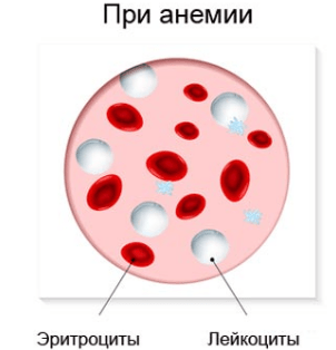 Клетки крови при анемии