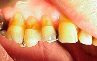 Клиновидный эффект - желтые зубы