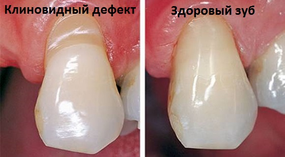 Клиновидный дефект и здоровые зубы
