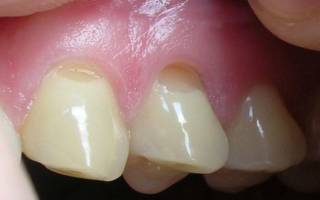Трещина у основания зуба