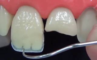 Наращивание зубов композитными материалами