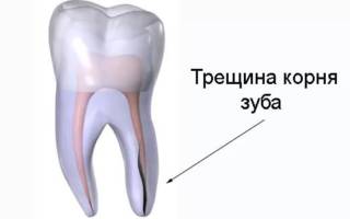 Трещина корня зуба