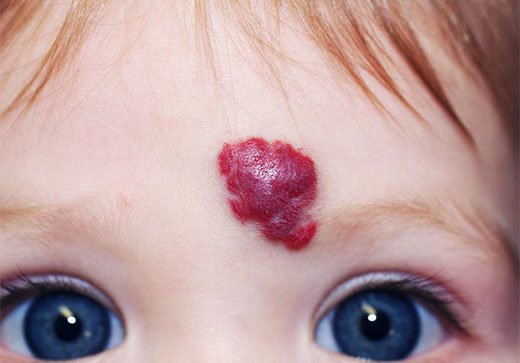 красное пятно на лице у ребенка