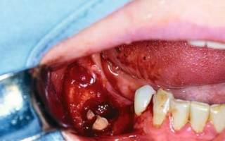 Кровотечение при удалении зуба