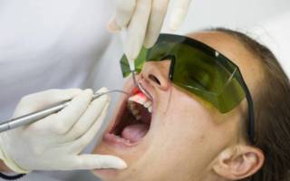 Лазерное лечение зубов всё, что нужно знать о процедуре в 2020 году