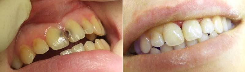 Лечение зубов - до и после