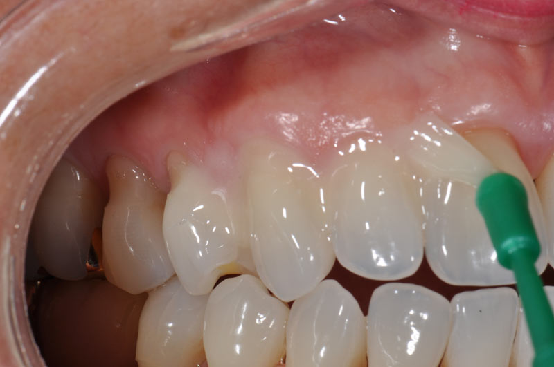 Реминерализация зубов при клиновидном дефекте